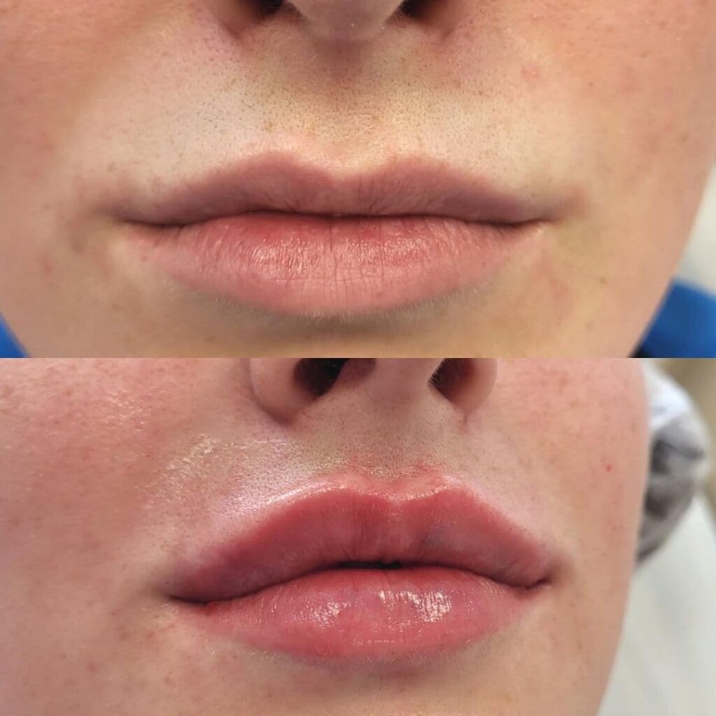 увеличение губ до и после процедуры