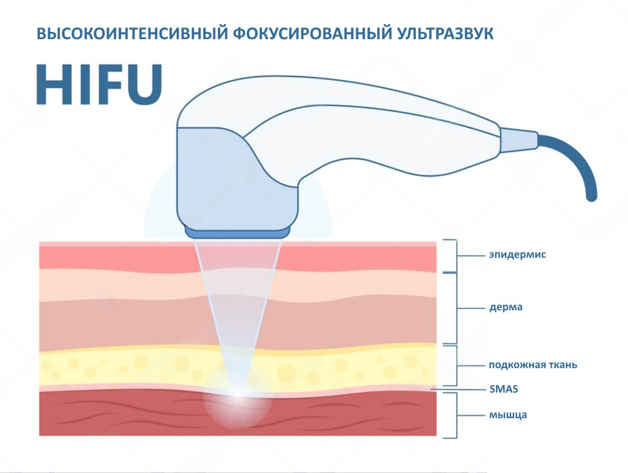 HIFU (High Intensity Focused Ultrasound)