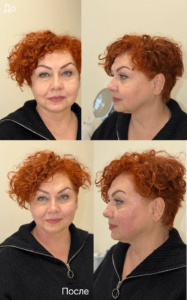 Реабилитация после SMAS-лифтинга до-после