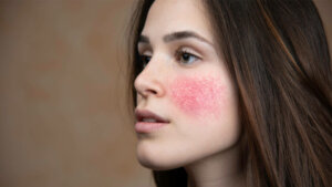 Фотолечение розацеа